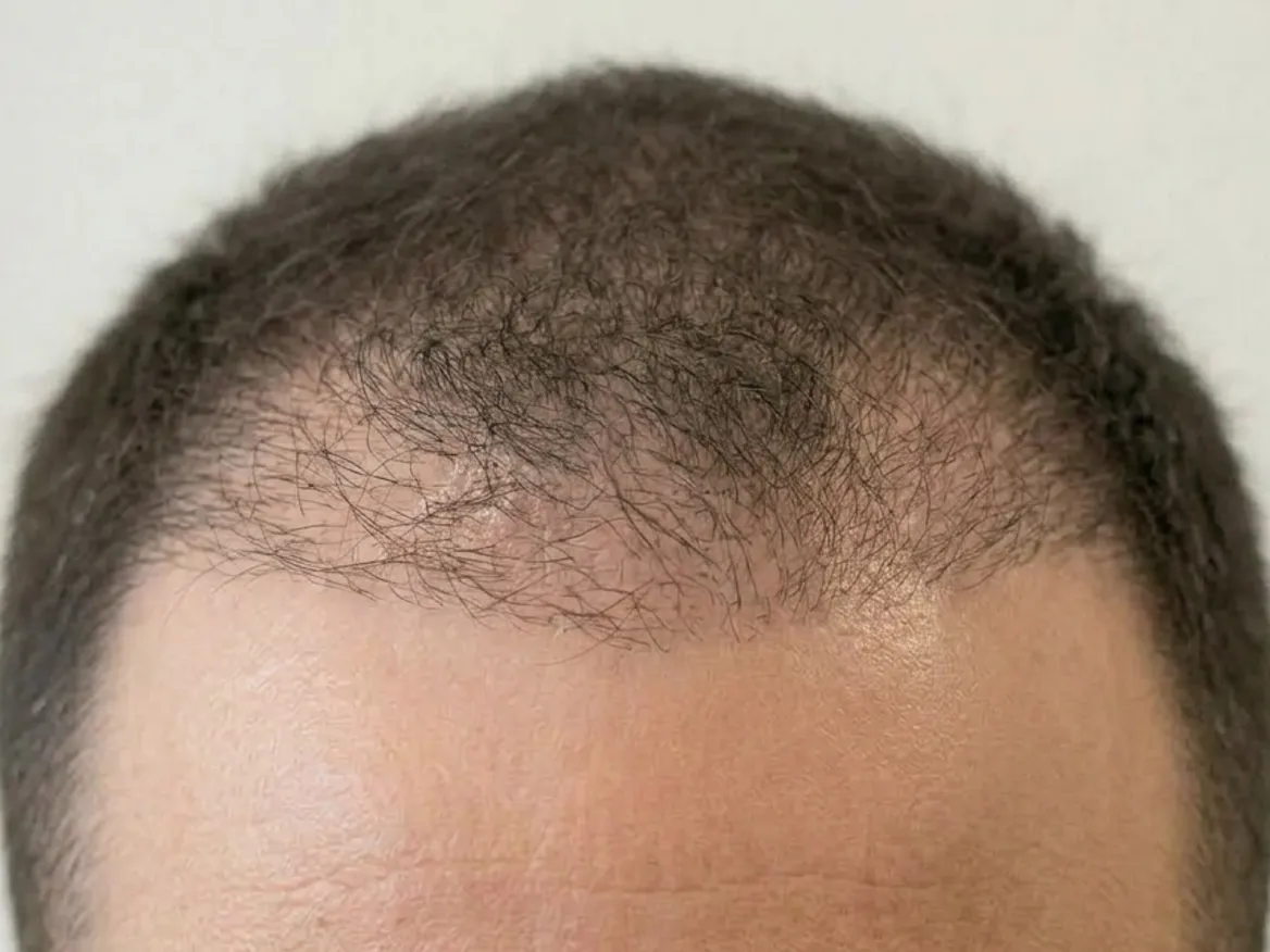 Cuir chevelu avec des zones clairsemées au début du traitement