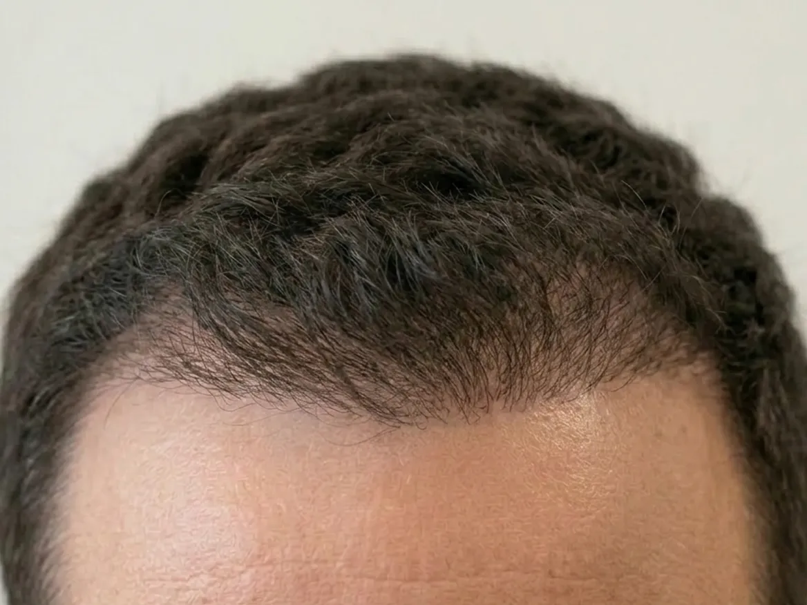 Cuir chevelu avec les premiers cheveux fins qui repoussent